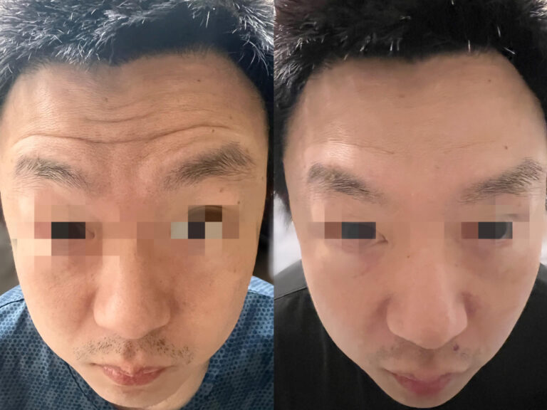 botox before after