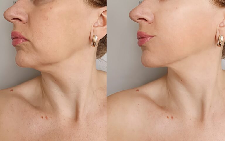 Woman,Double,Chin,After,Treatment